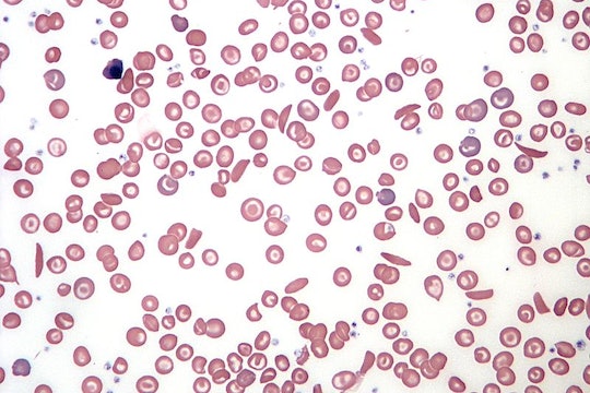 sickle cell blood cells under the microscope against a white background